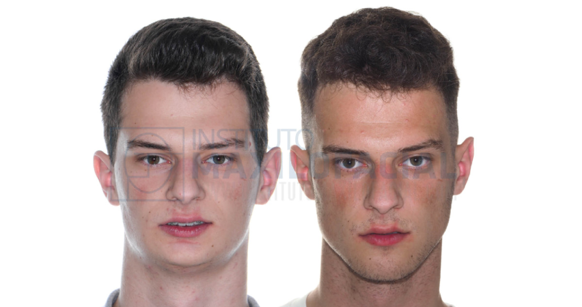Imagen de antes y después de un paciente que se sometió a la cirugía ortofacial en el Instituto Maxilofacial de Barcelona / CEDIDA