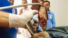 Un médico extraer un pez de la garganta de un pescador / TIKTOK