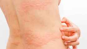 La enfermedad de Kawasaki puede manifestarse con sarpullidos en la piel / EP