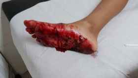 Las heridas en el pie del niño herido