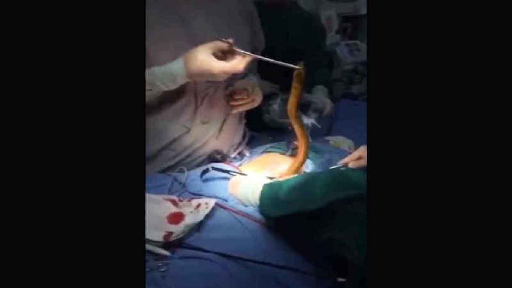 La anguila seguía viva en el estómago del paciente