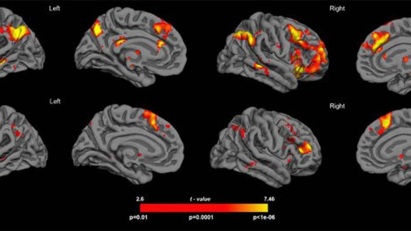 La figura muestra el patrón de activación cerebral que permite descartar un estímulo como falso recuerdo. En el grupo de control las activaciones son mucho más intensas y extensas que en los consumidores de cannabis.