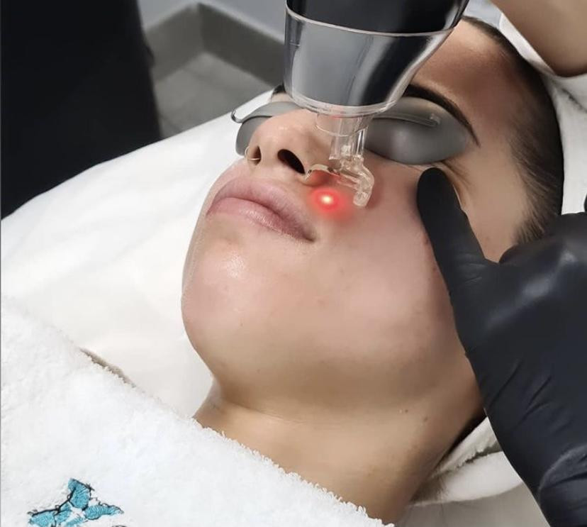 Lucía se somete a un tratamiento facial de láser Co2 fraccionado / INSTAGRAM