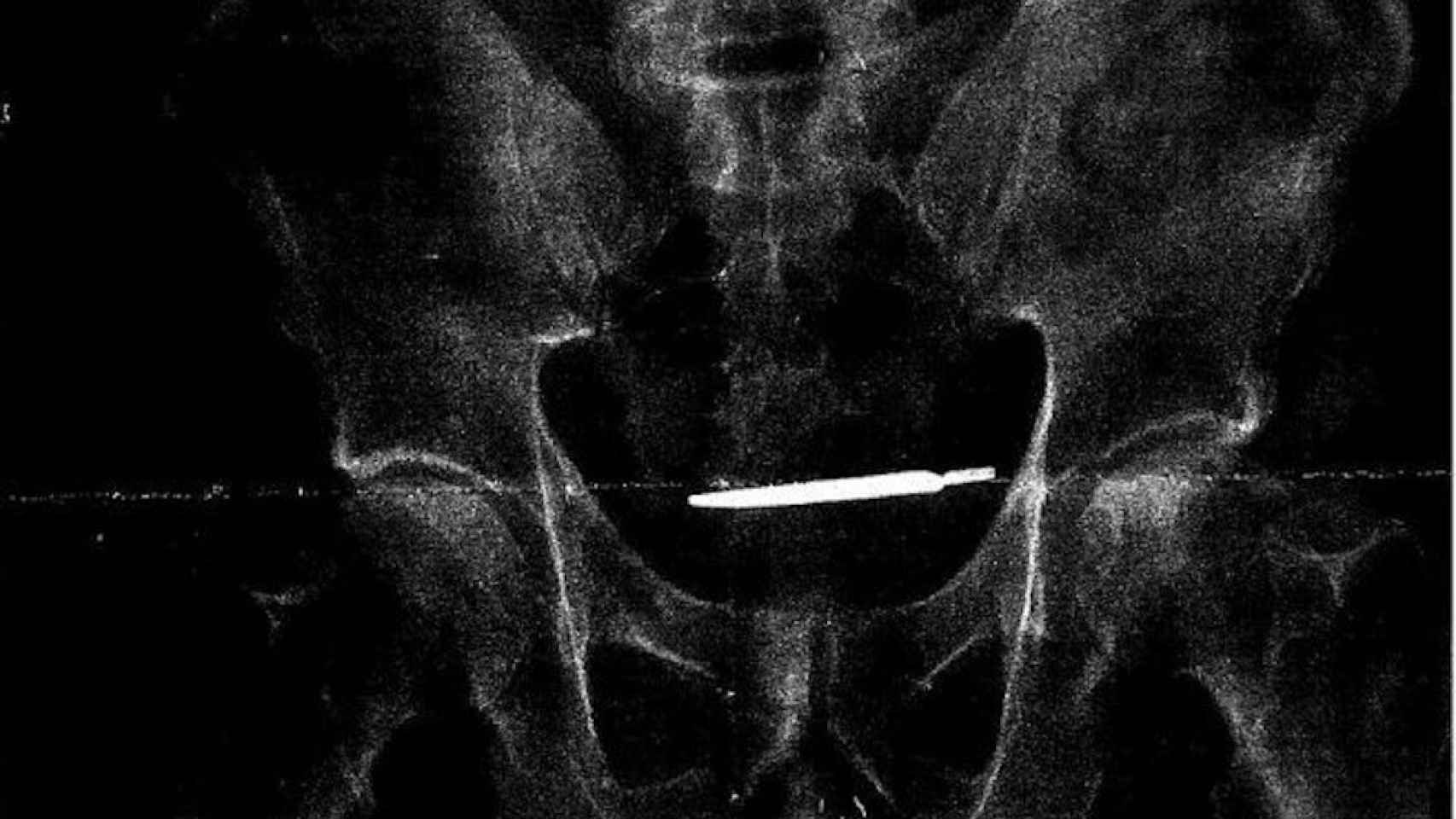 La radiografía del paciente donde se observa el bisturí
