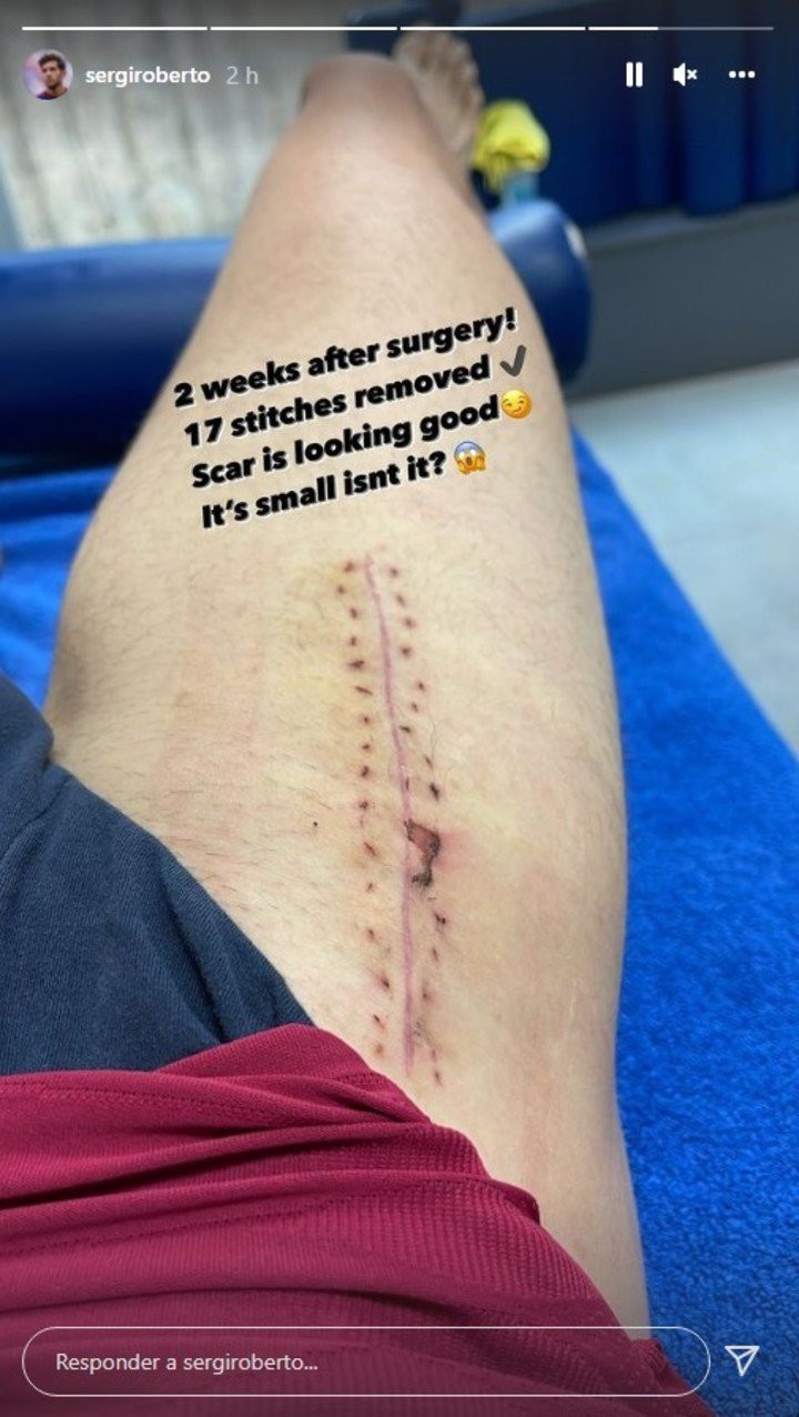 Sergi Roberto muestra la cicatriz de su operación : REDES
