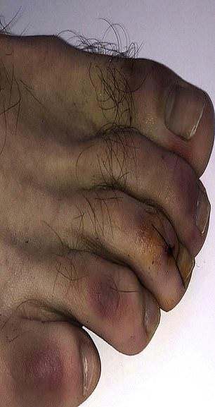 Dedos de los pies inflamados por el Covid, conocidos como 'Covid toe'