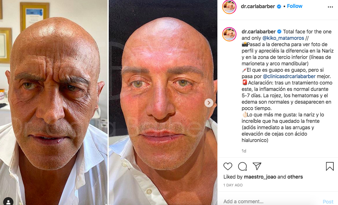 Carla Barber muestra el antes y el después de la cara de Kiko Matamoros / INSTAGRAM