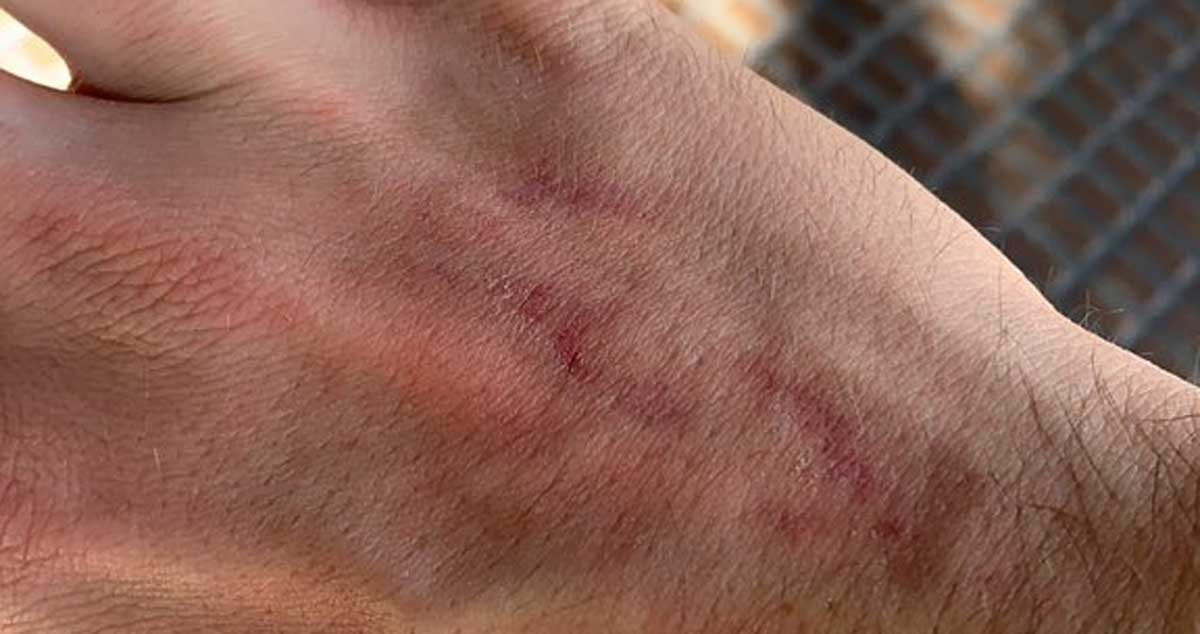 La víctima de la agresión homófoba, mostrando su herida en la mano tras recibir una patada / TWITTER