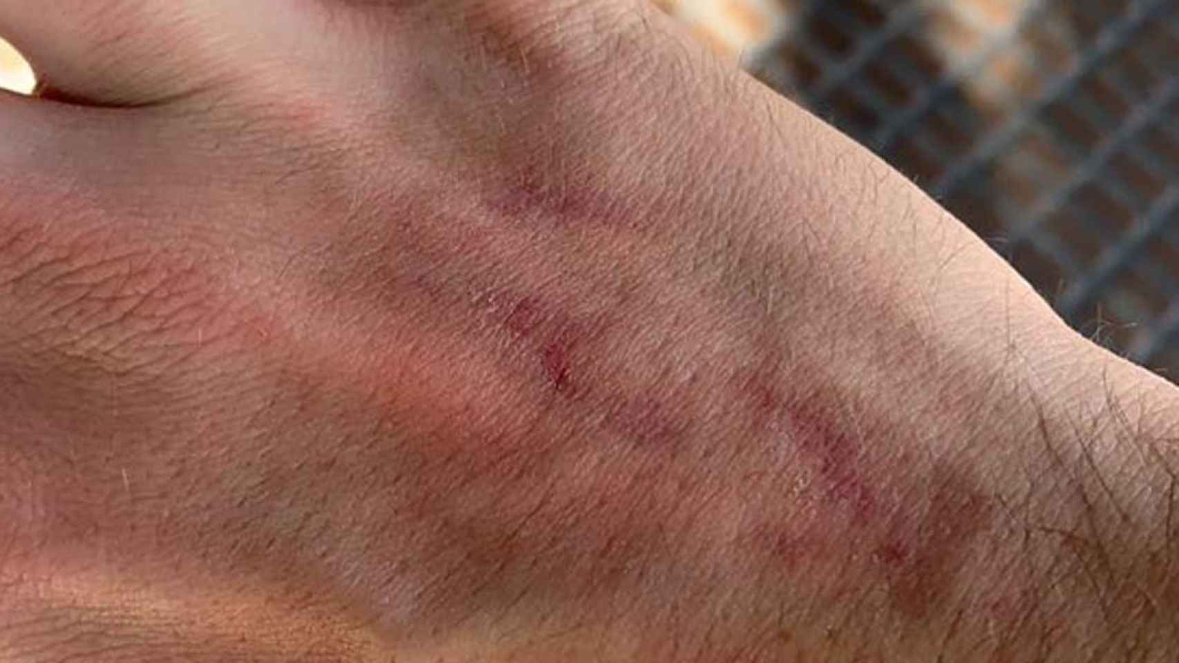 La víctima de la agresión homófoba, mostrando su herida en la mano tras recibir una patada / TWITTER