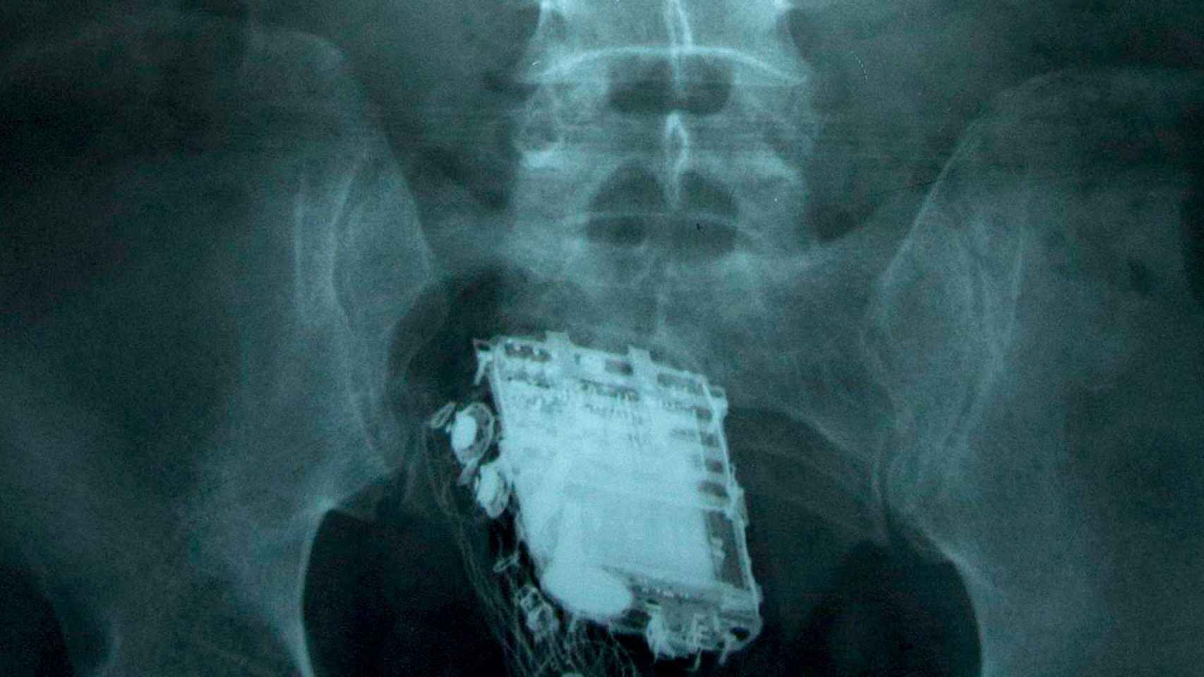 Radiografía de un preso con un teléfono introducido por el recto / CG