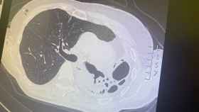 Vista de un TAC pulmonar de la periodista Pilar Eyre, donde se ve su pulmón derecho expandido en la parte superior / CEDIDA