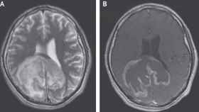 Una radiografía del cerebro con el tumor