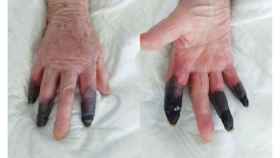 Imagen de cómo quedaron los dedos de la mujer tras sufrir el coronavirus / EJVES