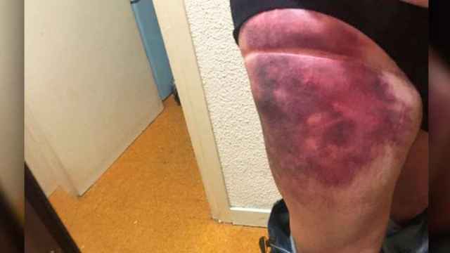 Las heridas del actor Pep Cruz tras ser embestido por un patinete eléctrico / TWITTER