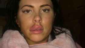 Jessica Myott y sus labios hinchados tras inyectarse relleno / TWITTER
