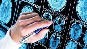 Pruebas médicas de la afectación cerebral del Alzheimer / EP