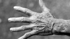La dilatación de la cápsula sinodial provoca artritis.