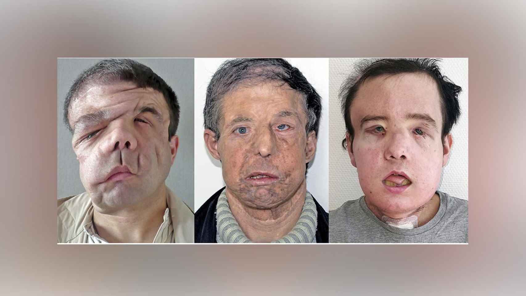 Los tres rostros de Jérôme Hamon / HEGP AP-HP