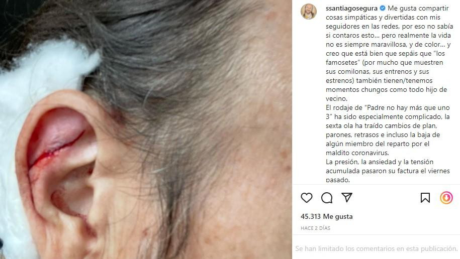 Herida de Santiago Segura / INSTAGRAM
