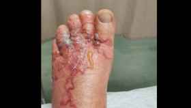 El pie del turista infectado por el parásito