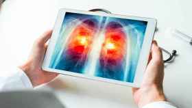 Radiografía digital acerca de un cáncer de pulmón en una imagen de archivo / EP