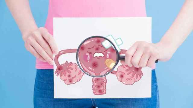 Representación gráfica de un mioma uterino: la radiofrecuencia es una alternativa recomendada para su tratamiento / TEKNON