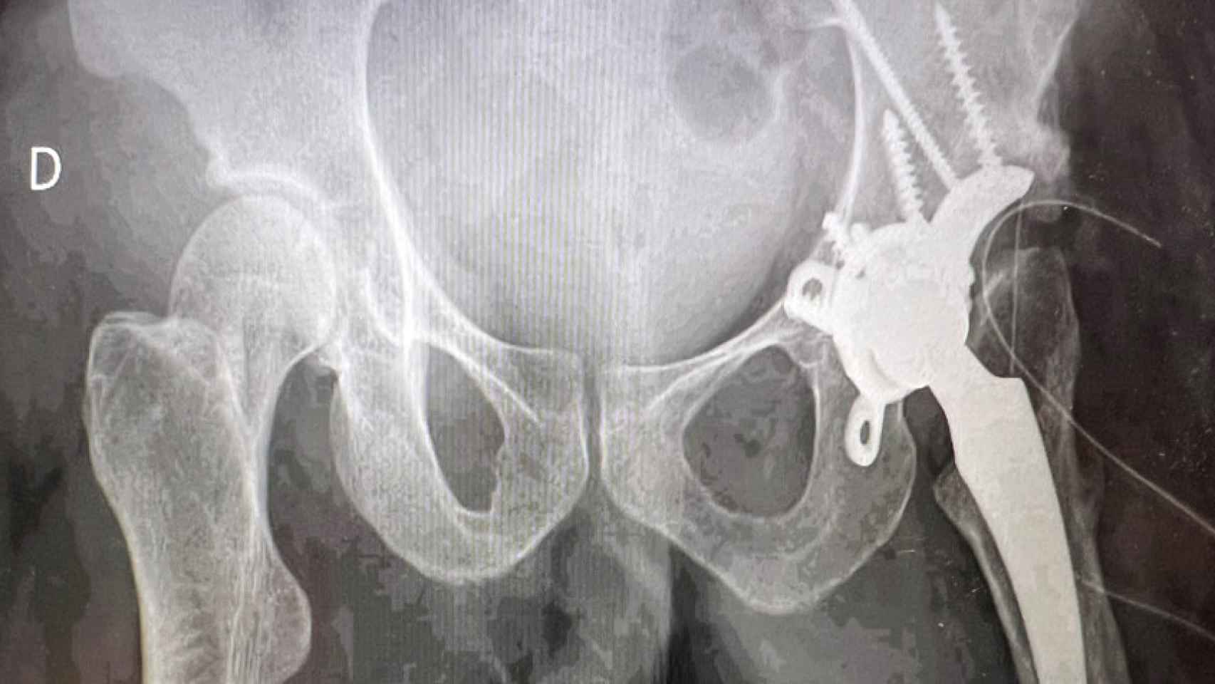 Radiografía del paciente tras la intervención con la prótesis 'custom made' / HOSIPITAL UNIVERSITARI SAGRAT COR