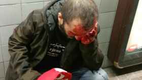 Brutal agresión a un participante en la manifestación de Jusapol en Barcelona: El hombre agredido en el metro de Barcelona tras participar en la manifestación de Jusapol / TWITTER