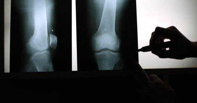 Radiografía de unos huesos afectados de osteoporosis / EFE