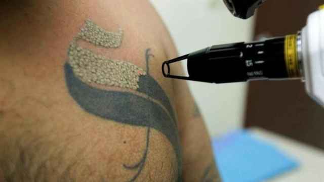 Imagen del proceso de eliminación de tatuajes / EFE