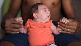 El virus del zika puede provocar microcefalia en los recién nacidos.