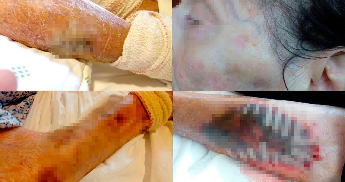 Fotos de las lesiones que sufrió M. durante su estancia en DomusVi Can Buxeres / CG