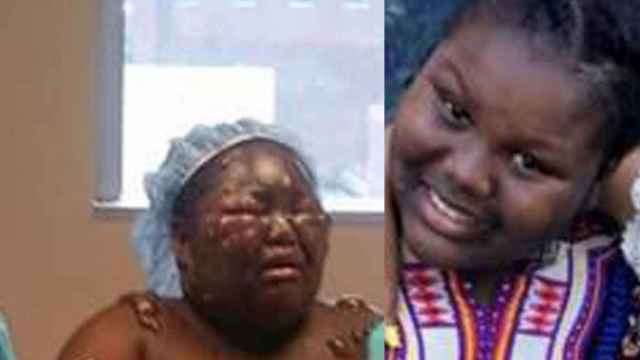 La niña en una foto antes y después del incidente