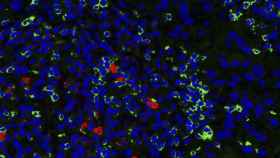 Linfocitos NK actuándo en un tumor de cáncer de mama HER2 positivo / HOSPITAL DEL MAR