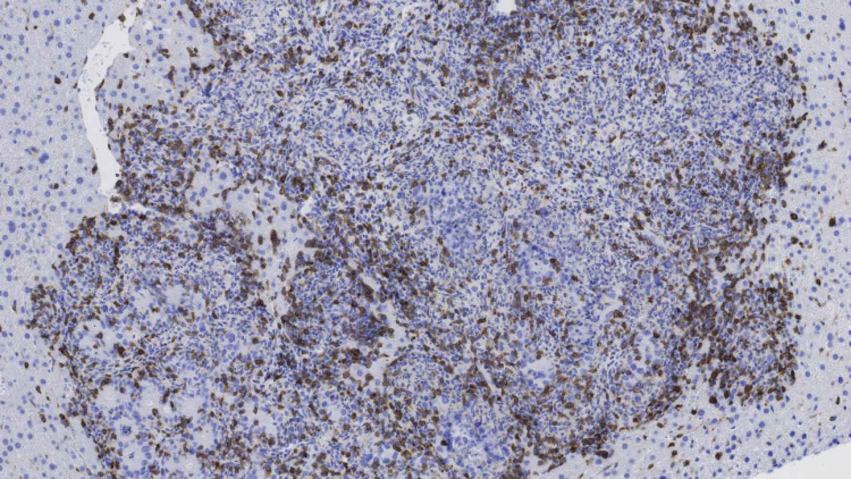 La imagen muestra un tumor metastásico de colon infiltrado por el sistema inmune / DANIEL TAURIELLO IRB BARCELONA