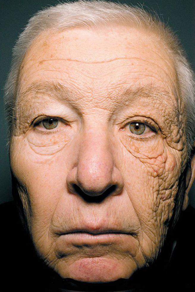 Una foto del camionero con melanoma en el rostro por la exposición al Sol