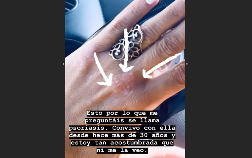 Laura Fa confiesa a sus seguidores de Instagram que sufre psoriasis / INSTAGRAM