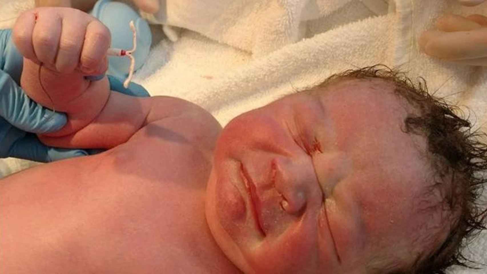 El bebé que nació con el DIU de su madre en la mano