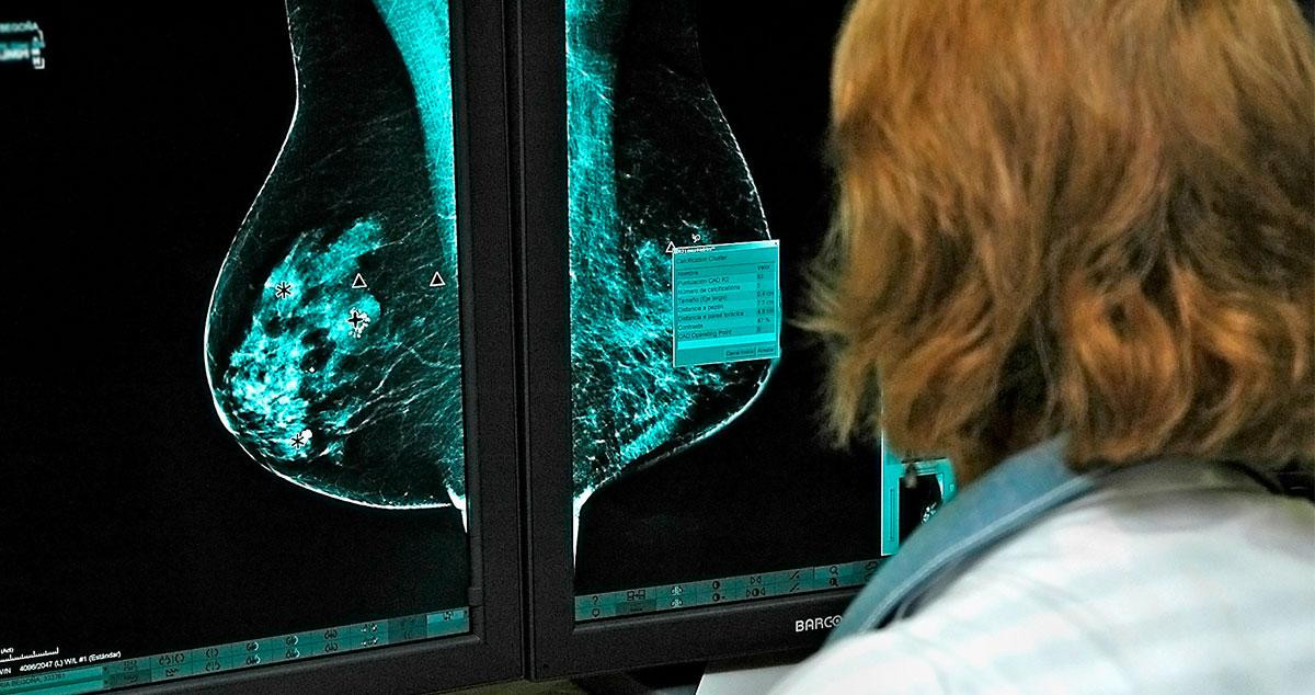 Una doctora analiza una radiografía de un pecho con cáncer de mama / EP