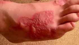 Imagen de la infección de la piel del joven cedida a los medios / CREATIVE COMMONS