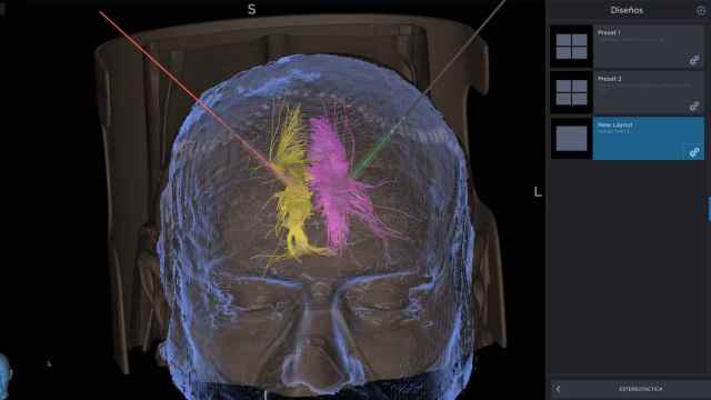 Estimulación cerebral profunda para tratar el dolor neuropático / HOSPITAL DEL MAR