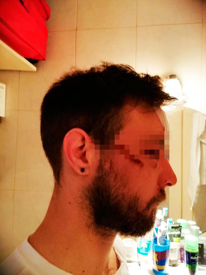 Jean-Baptiste, a quien cinco ladrones patearon la cabeza en la calle en Barcelona para robarle el móvil / CG