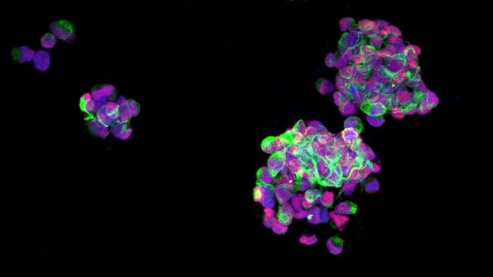 Imagen de microscopía de fluorescencia de células de glioblastomas, los tumores cerebrales más frecuentes y agresivos para los cuales se ha hallado un nuevo fármaco / GLIOMALAB
