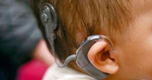 Implante coclear de un niño que padece diversidad funcional auditiva que defienden los oralistas / GOOGLE