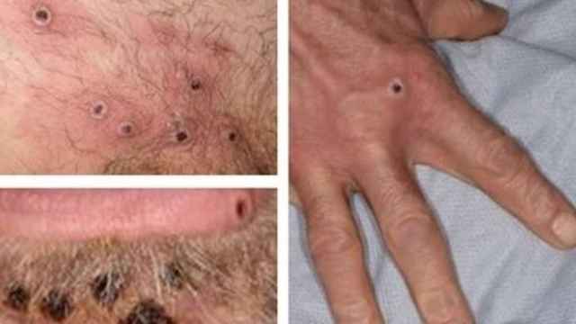 Lesiones en la piel causadas por la viruela del mono / EUROPA PRESS