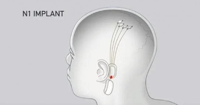 Proceso de implante del Link VO.9 / NEURALINK
