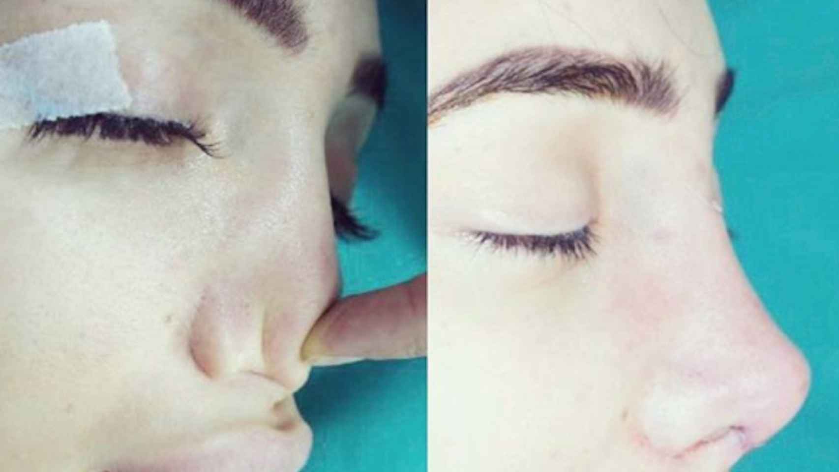 La modelo Chloe Khan durante su operación estética de nariz