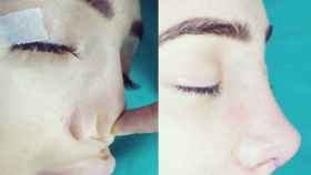 La modelo Chloe Khan durante su operación estética de nariz