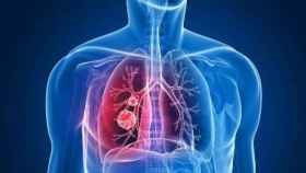 Representación de un pulmón con cáncer