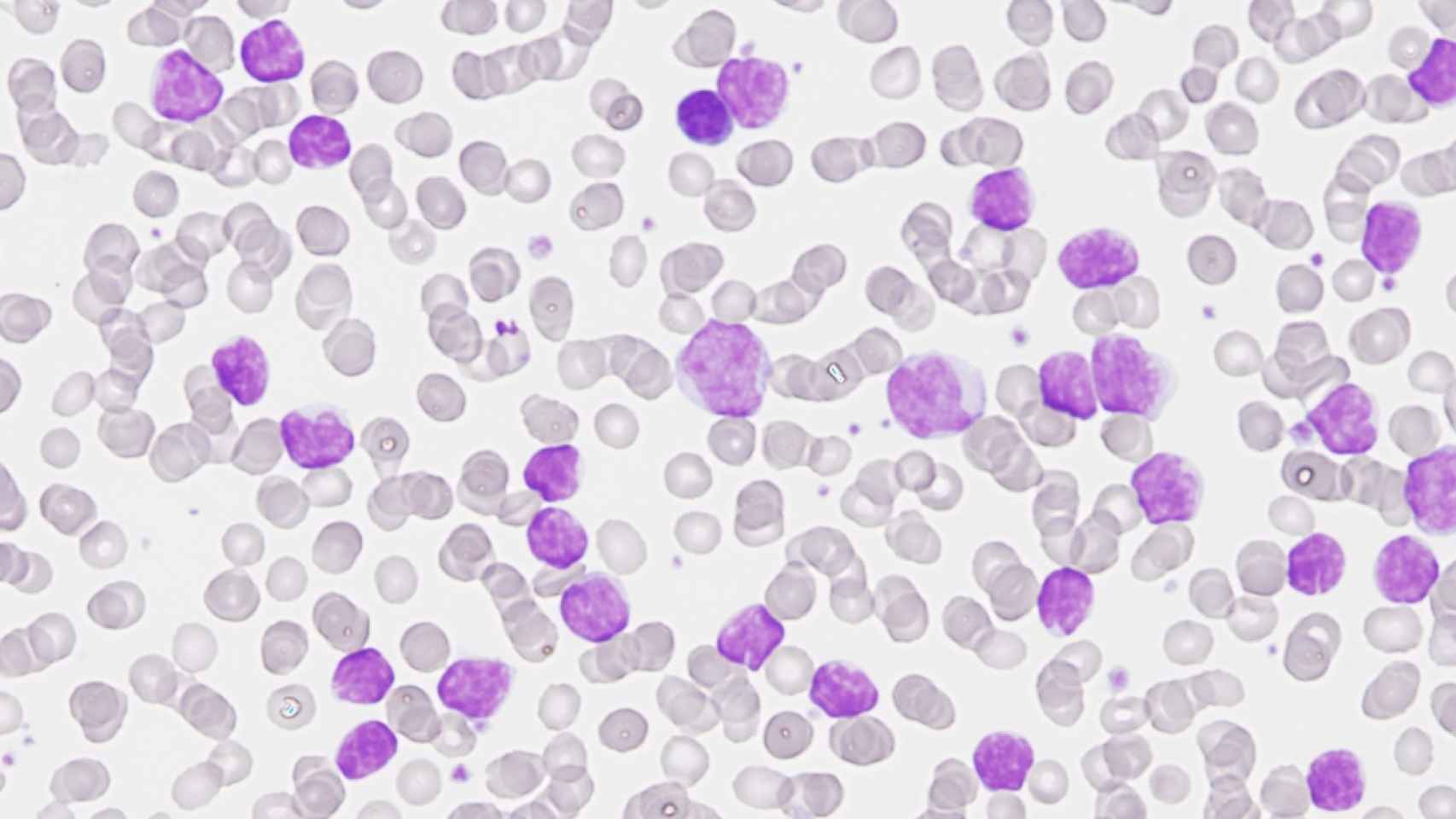 Un estudio completa el mapa de los cambios genéticos en la leucemia linfática crónica / EP